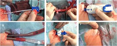 A Novel Plug-Based Vascular Closure Device for Percutaneous Femoral Artery Closure in Patients Undergoing Minimally-Invasive Valve Surgery